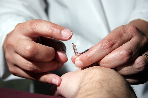 Doctor checking acupuncture