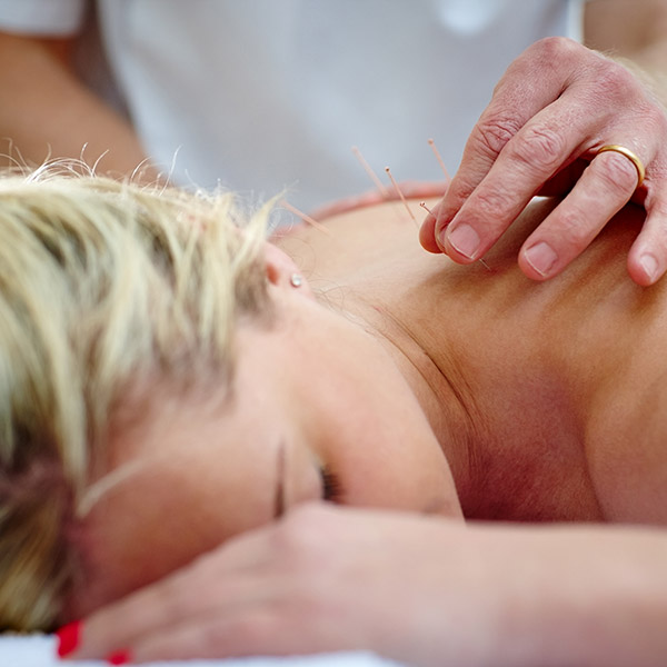 close-up of acupuncturist working on patient's back